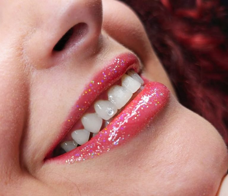 Joyería dental estética